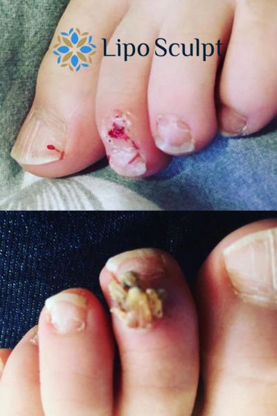 Wart removal customer results from Lipo Sculpt Byfleet