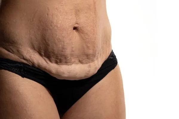 Lost the Weight but Not the Loose Skin? 1 image of womans stomach after weight loss showing loose skin Byfleet